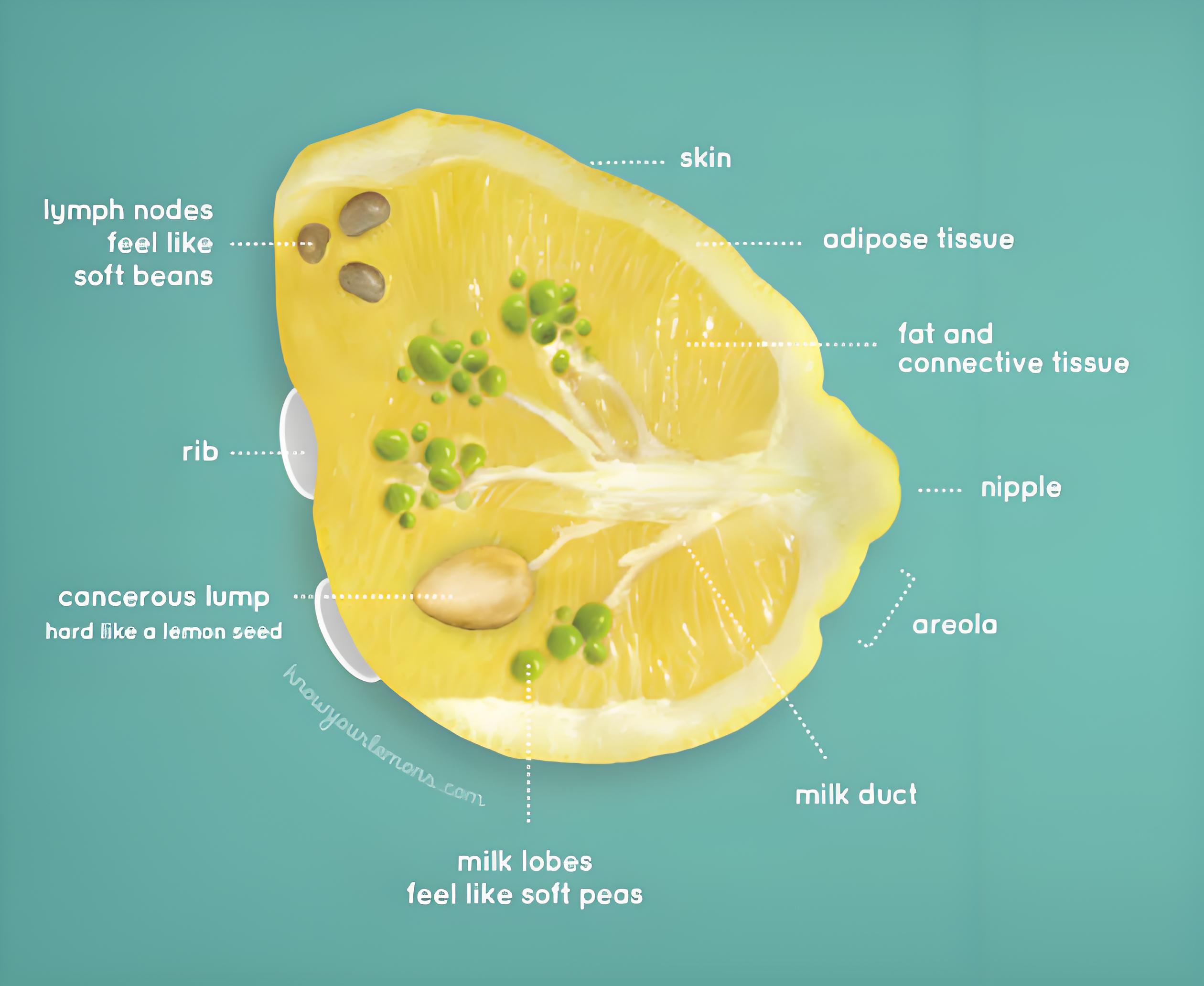 乳腺癌（Breast Cancer）