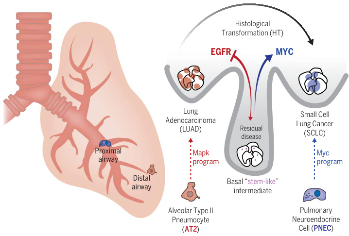 肺癌（Lung cancer）（二）