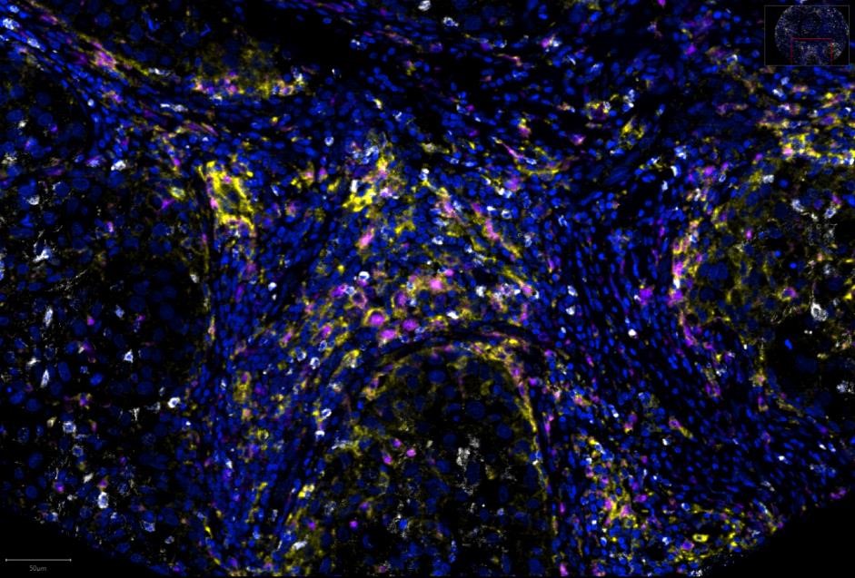 文献分享：多重免疫荧光鉴定高间质CD68⁺PD-L1⁺巨噬细胞