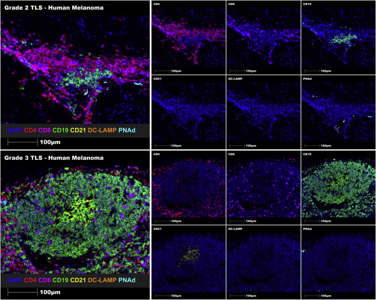 文献分享：多重免疫荧光在肿瘤三级淋巴结构研究中的应用