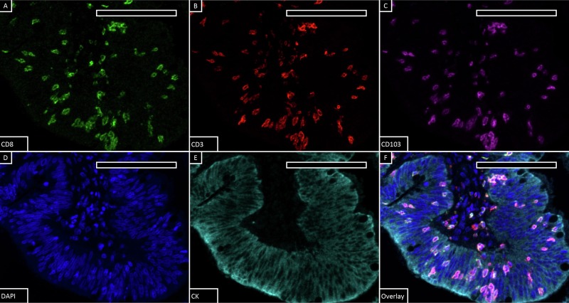 文献解析：多重免疫荧光染色结直肠肿瘤免疫微环境