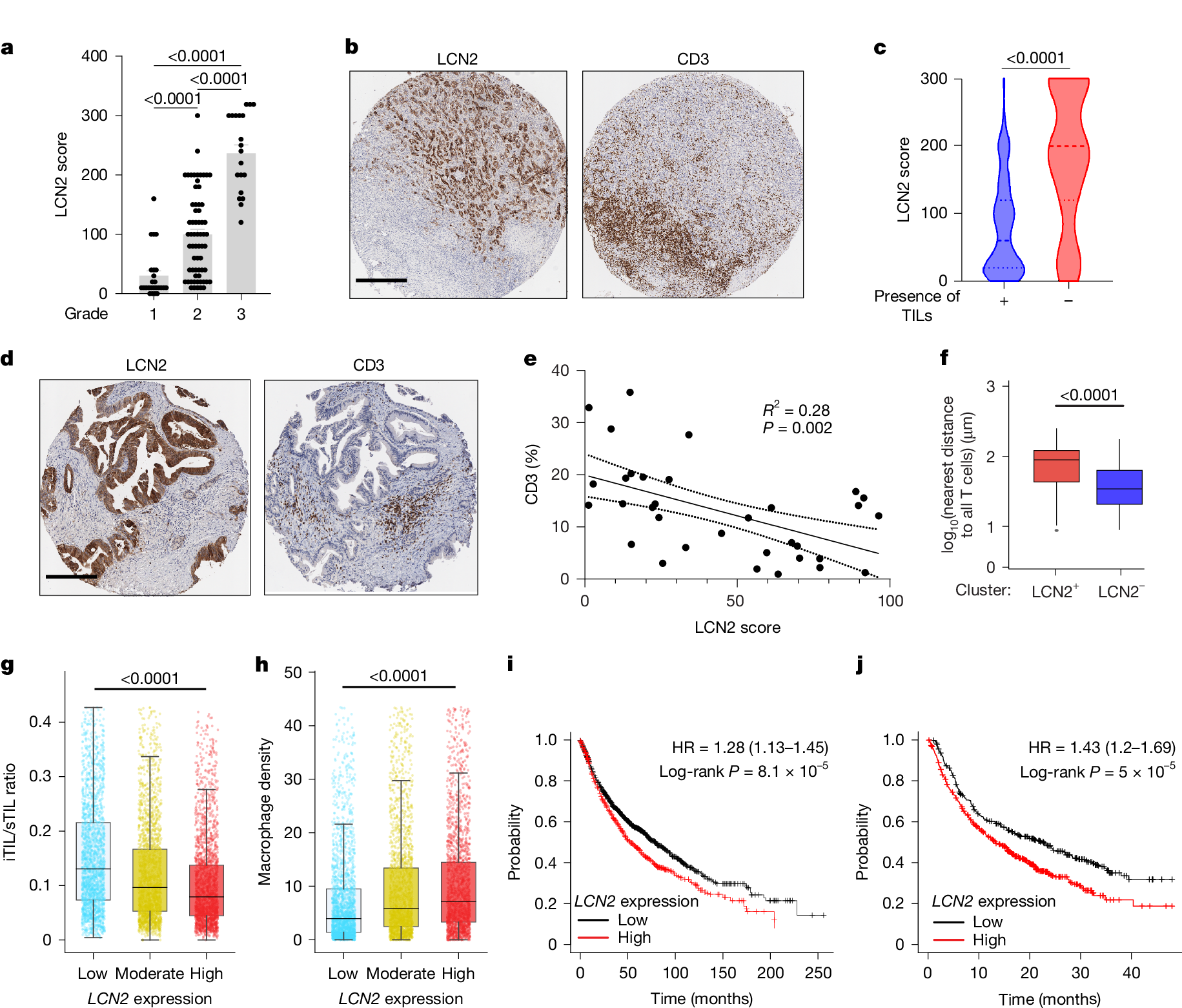 Fig. 4: LCN2 levels in patients correlate with higher tumour grade and reduced TILs.