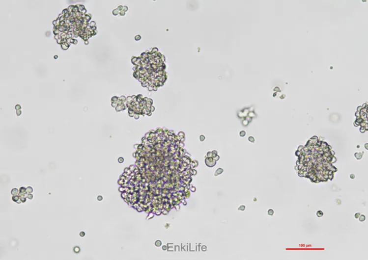人恶性非霍奇金淋巴瘤患者的自然杀伤细胞 NK-92